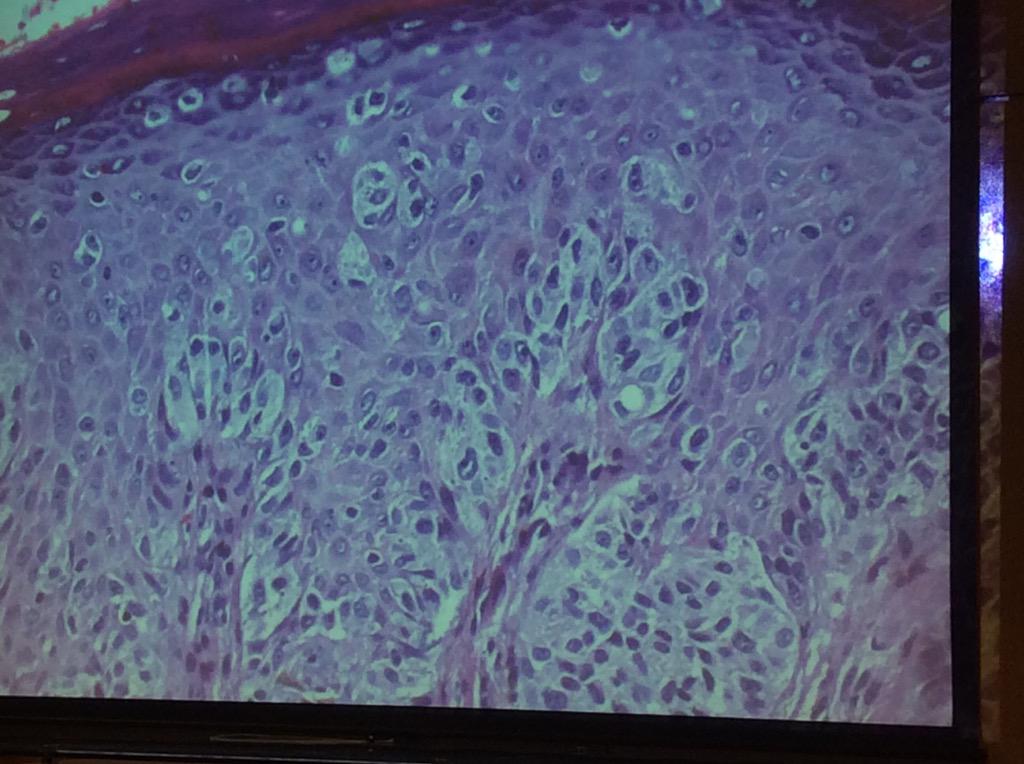 HassellLewis's tweet photo. Spitzoid #melanoma Challenging DDx, get help! look for prominent pagetoid spread #OSAP15 http://t.co/bmhCuqKUJH