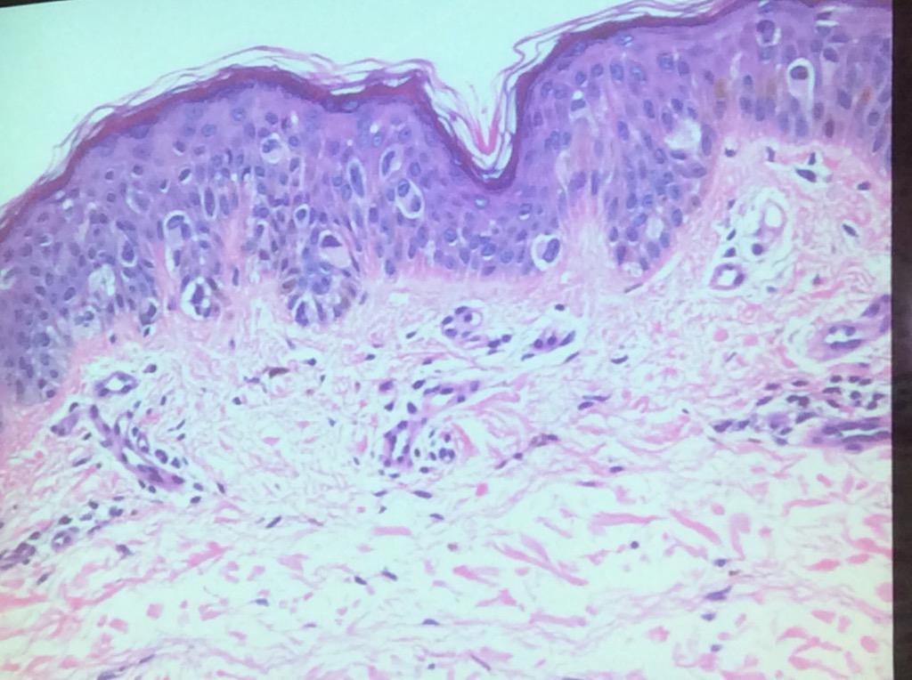 HassellLewis's tweet photo. Pagetoid #Spitz #Nevi challenging! Dr. Billings #OSAP15 SMALL, LE, young women, overlap w/ #melanoma #insitu re-excis http://t.co/je84P1Hxwx