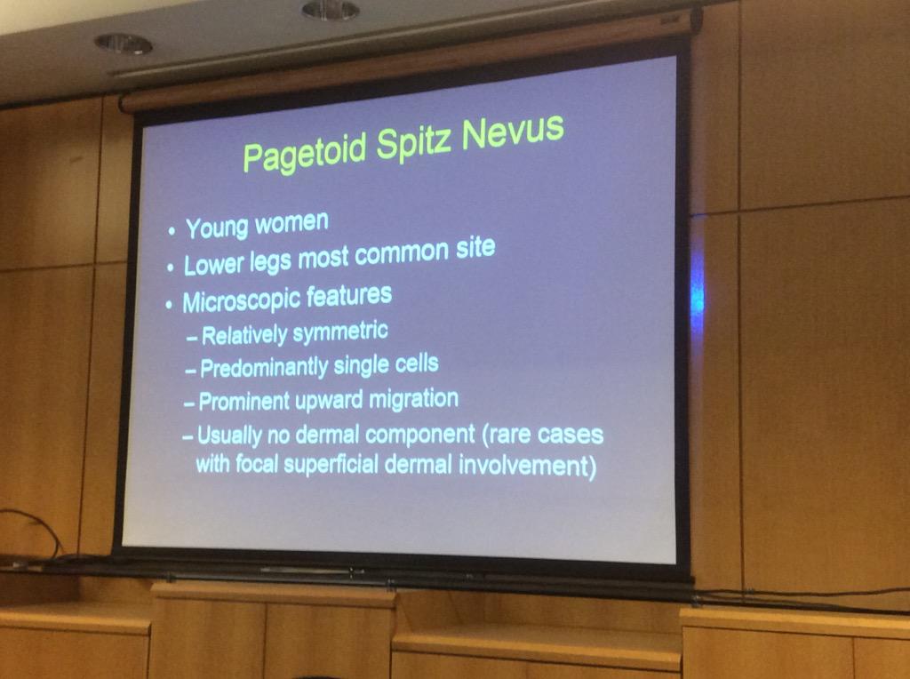 HassellLewis's tweet photo. Pagetoid #Spitz #Nevi challenging! Dr. Billings #OSAP15 SMALL, LE, young women, overlap w/ #melanoma #insitu re-excis http://t.co/je84P1Hxwx