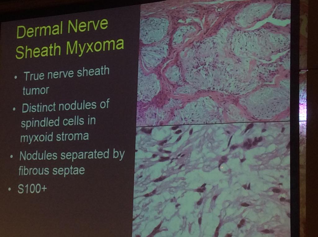HassellLewis's tweet image. Dernal nerve sheath myxoma differs from cellular neurothekioma Dr. Billings #OSAP15 S100 key