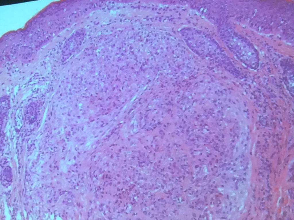 HassellLewis's tweet image. #epithelioid #sarcoma Dr, Billings #OSAP15 Catch early- may need SLN bx.