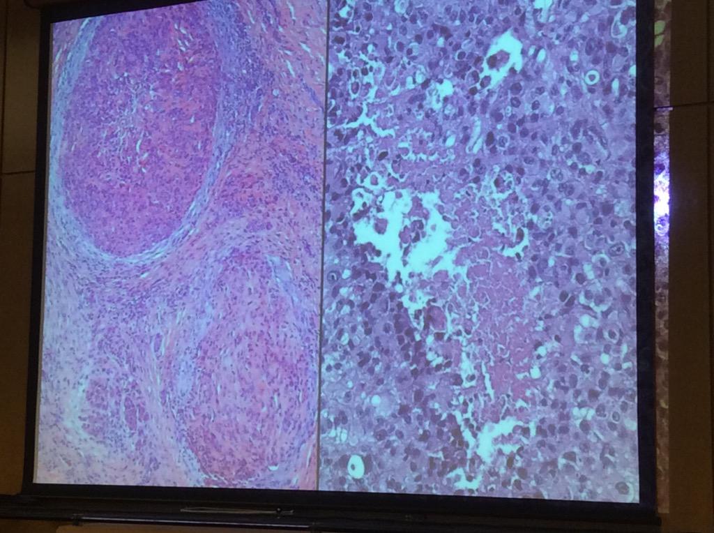 HassellLewis's tweet image. #epithelioid #sarcoma Dr, Billings #OSAP15 Catch early- may need SLN bx.