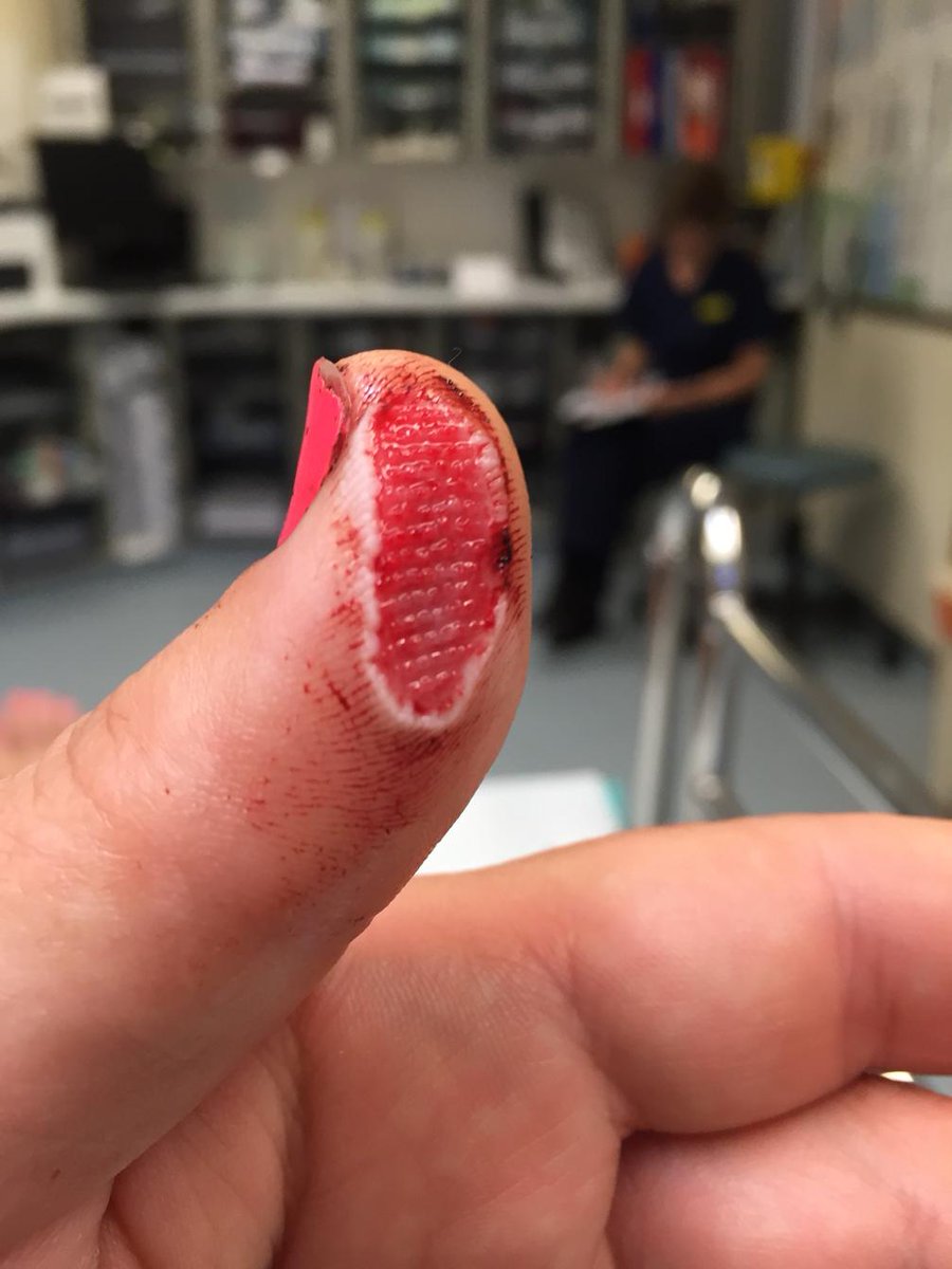 KirstieMAllsopp's tweet photo. Warning: Be very careful with mandolins &amp; Many thanks, as ever, to the lovely staff at Honiton Small Injuries unit. http://t.co/EkvNZoGrqa