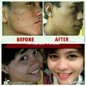 YukMaskerAlami's tweet photo. Kmu Berjerawat?Gunakan Masker Spirulina(dri Ganggang Biru) JERAWAT HILANG TNPABEKAS!pin:28550e0b sms/wa 081274366704 http://t.co/ygyuXFVZCk