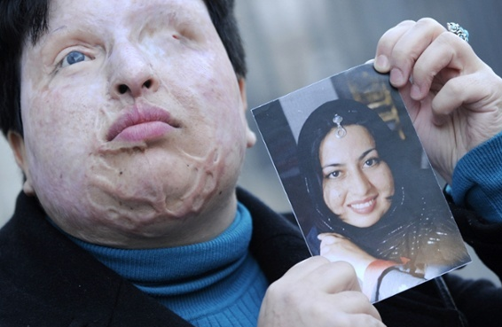 guardian's tweet photo. Ameneh Bahrami: was I right to pardon the man who blinded me with acid? http://t.co/8FatkieNNQ http://t.co/CdXiakWPOq