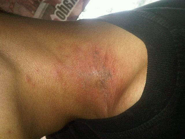 agusangel1's tweet photo. Kena hulubalang leher agus ni, perih sakit dan seperti terbakar rasanya http://t.co/KgEsN93trp