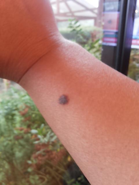 Negracox's tweet photo. #malditolunesmp  este es de nacimiento en la muñeca. .. :/ http://t.co/KEersSdDNZ