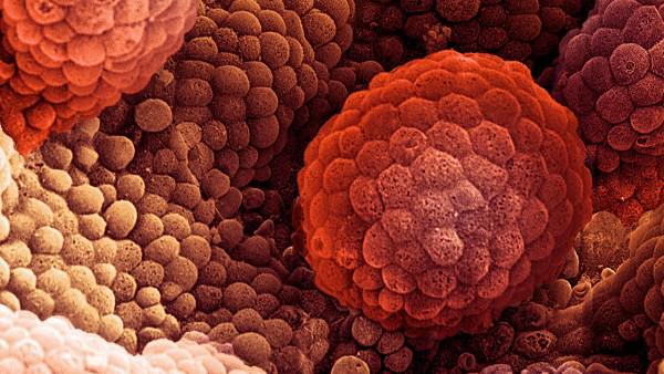 DanaFarber's tweet photo. #Breastcancer drug may help men with prostate cancer: http://t.co/Vwnk90S3hY #pcsm http://t.co/Nf0E5SHCP5