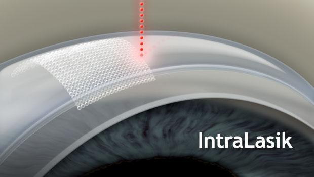 LaserEyeSV's tweet photo. All-Laser LASIK: Information From Medical Peer Reviews-
http://t.co/wNeSgcl83E #IntraLASIK #WavefrontLASIK #LASIKNews http://t.co/x8VPpK9H7D