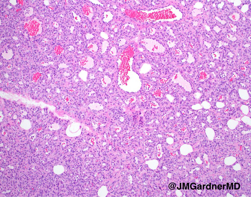 DermpathUAMS's tweet photo. Infantile hemangioma. Cellular lobules composed of small well formed vessels.GLUT1+ #dermpath #dermatology #pathology http://t.co/6bLTxstcMm