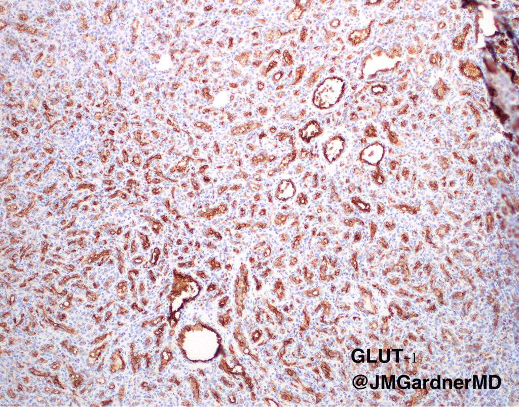 DermpathUAMS's tweet photo. Infantile hemangioma. Cellular lobules composed of small well formed vessels.GLUT1+ #dermpath #dermatology #pathology http://t.co/6bLTxstcMm