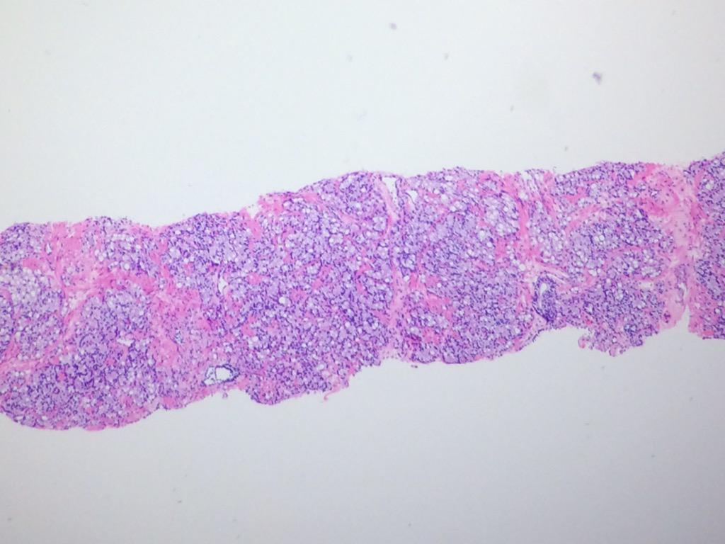 TheSagePatel's tweet photo. Prostatic adenocarcinoma with signet ring cells #gupath #pathology http://t.co/QBCWmXf8vT