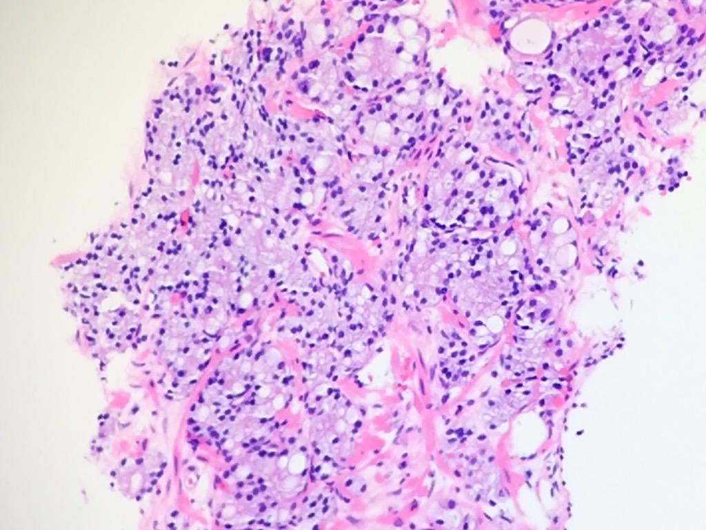 TheSagePatel's tweet photo. Prostatic adenocarcinoma with signet ring cells #gupath #pathology http://t.co/QBCWmXf8vT