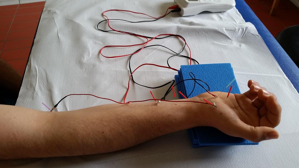 cale86's tweet image. DN carpal tunnel syndrome #dryneedling #jamesdunning