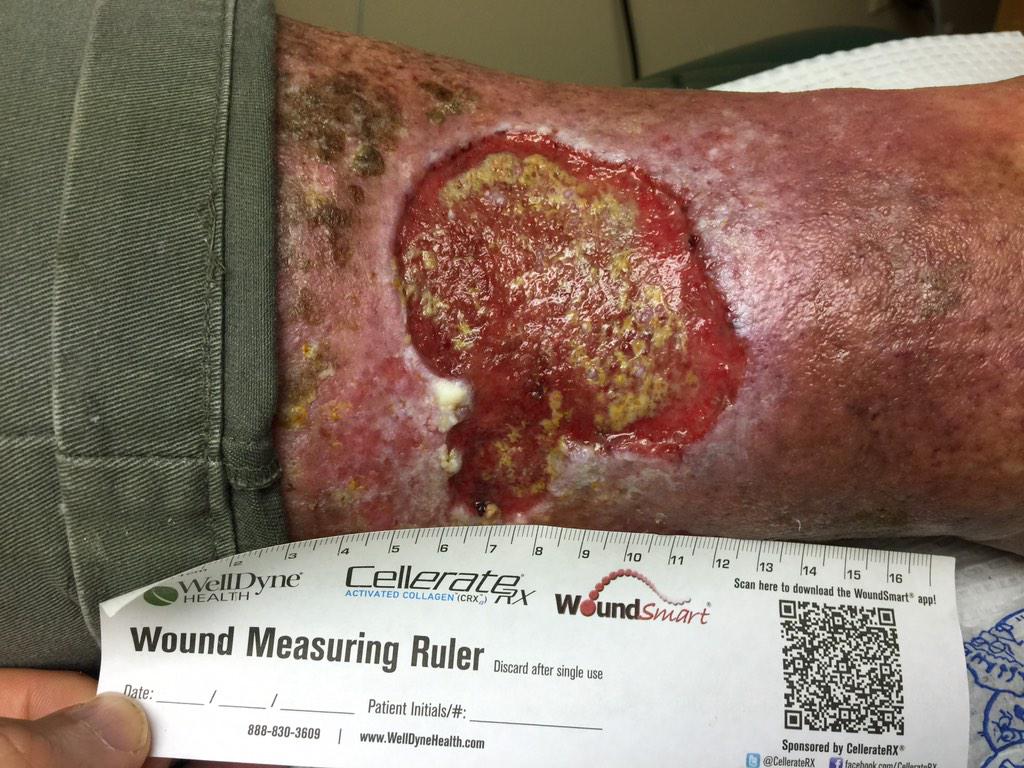 WoundSmart's tweet photo. Long standing non healing leg ulceration . What is your first move? #woundcare http://t.co/w5EjLSY3Al