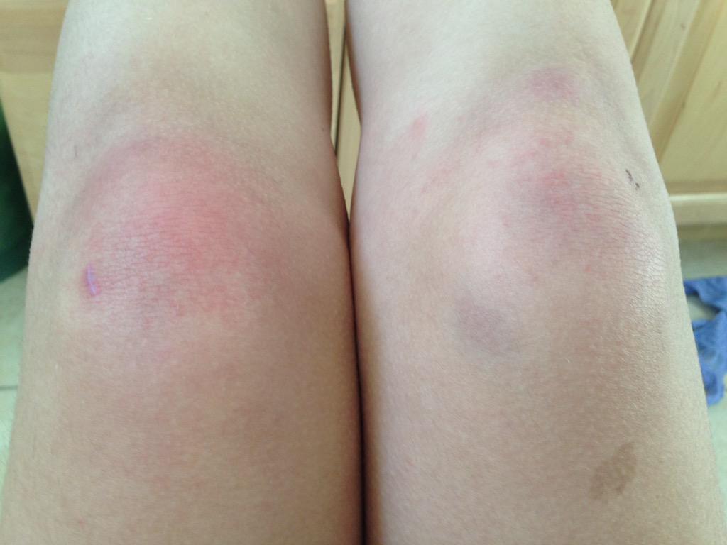 htrugbywounds's tweet photo. @nicoleeebtc and @aniajaroszynski really kNEED to ice their legs for all the upcoming games this week! http://t.co/gXhvt1Mla6