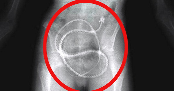 Adult_Page's tweet photo. You Won't Believe What The Doctors Have Found Inside Those People Bodies.. Yuk! http://t.co/UfI6pz2yVU … http://t.co/8XGTu5GWQ3