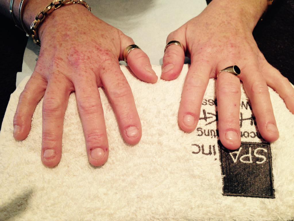 jemmakerroo's tweet photo. Before an after pics of severely bitten nails ❤️ acrylic with shellac xx http://t.co/CADxcWveew