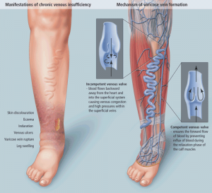 DrJuliusGarvey's tweet photo. An Overview of Chronic Venous Insufficiency and How a Vein Specialist in Long Island ... - http://t.co/MBdigszrVL http://t.co/0TYbttSz1A