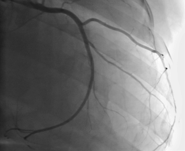 JeanMarcoMD's tweet photo. V unusual case: a patient with a stabbed heart! View 2 and 3D echocardiograms http://t.co/AggZx9nHP3 http://t.co/cszhneah4f