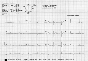 PCRonline's tweet photo. Teenager presenting w/ NSTE-ACS related to large thrombus within left main http://t.co/InWypYgi0k http://t.co/bLiPnQBjKj