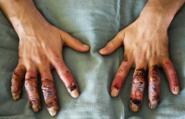 Comonsolution24's tweet photo. Treatments of frostbite https://t.co/GKyj5nmP7N http://t.co/vfRM4y0XWv