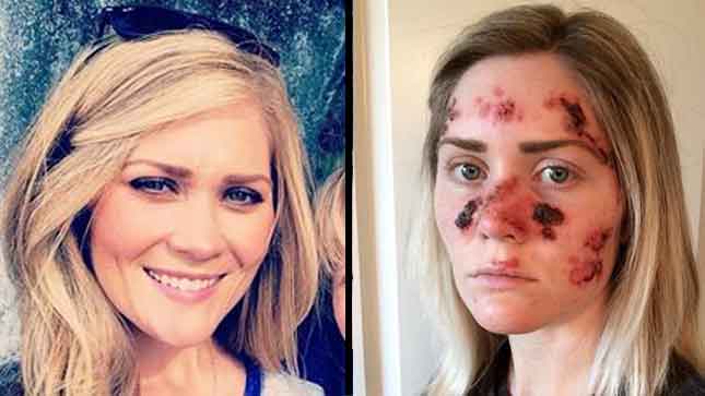 fox12oregon's tweet image. Woman who used to tan frequently shares photo of skin cancer treatments to raise awareness.
kptv.tv/1Jdllx4