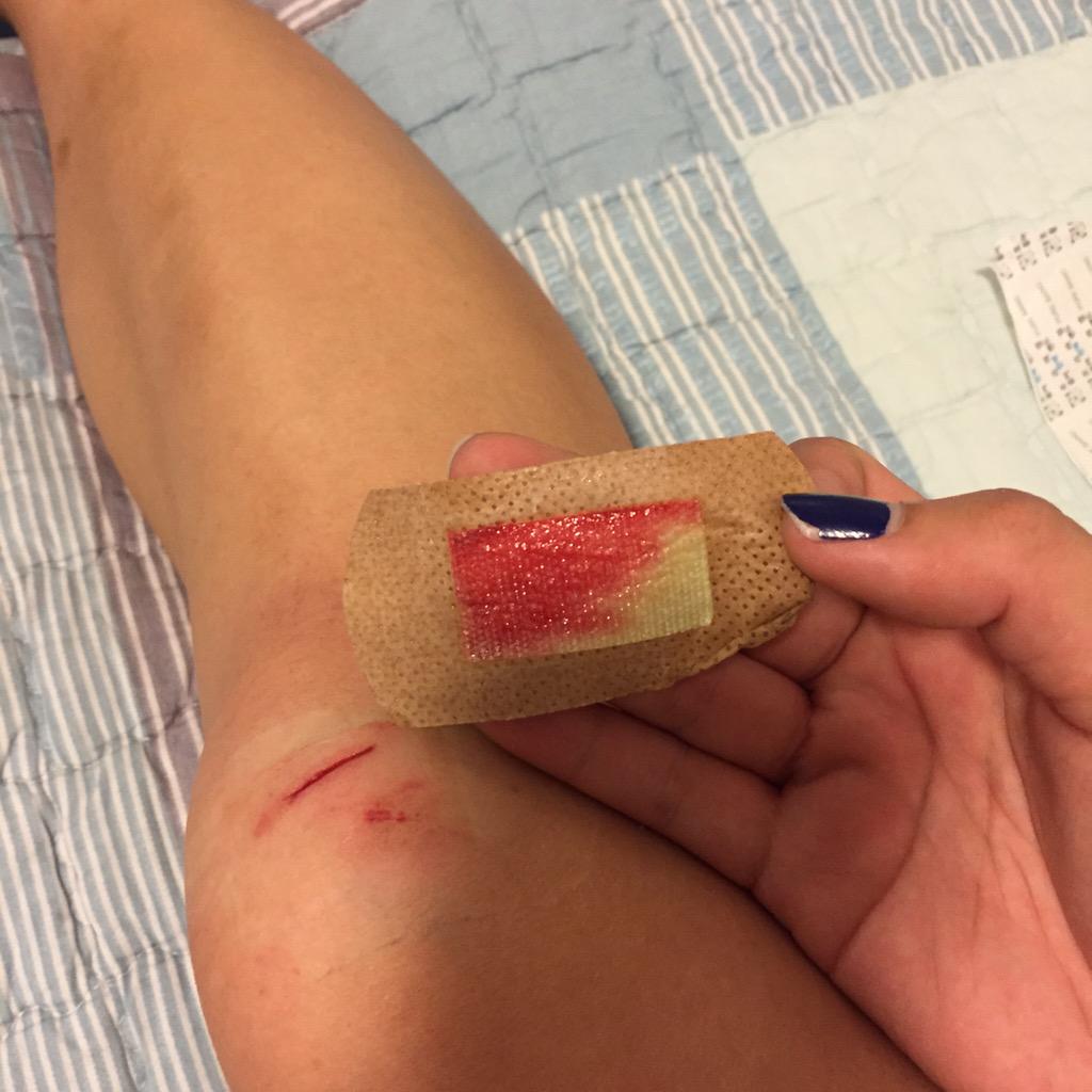 _creamyy's tweet photo. Seems like I always have an injury to keep as a memory for every trip. -_- http://t.co/b6xd9oE2WE