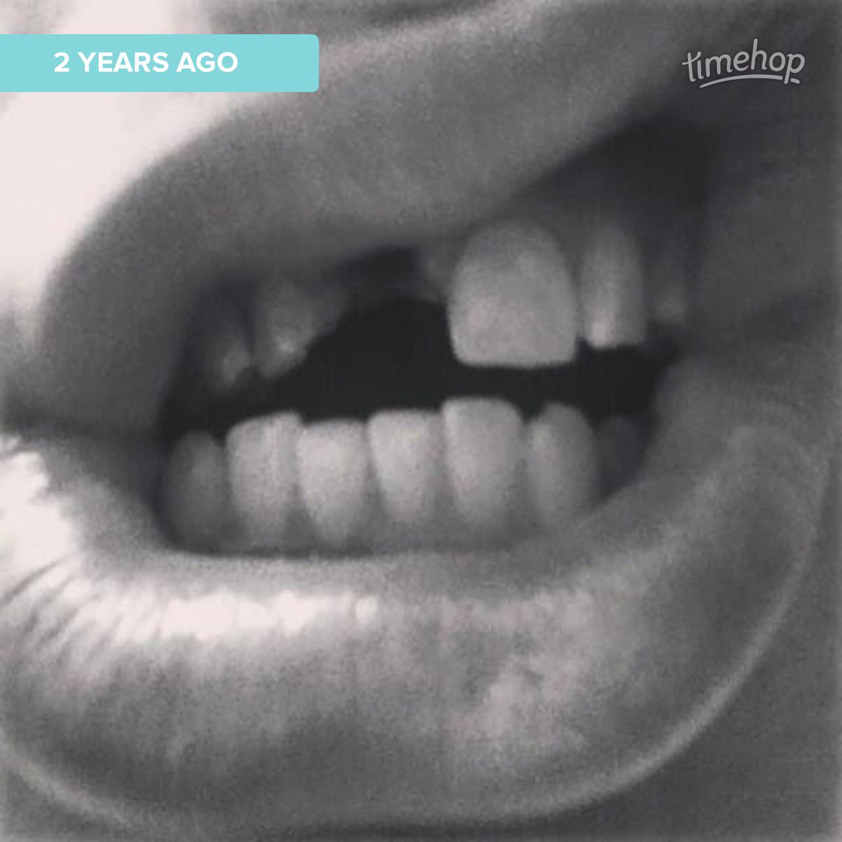 CodyLoss's tweet image. #Tbt to when I got my tooth removed! #ToothlessWonder timehop.com/c/t:3344054833…
