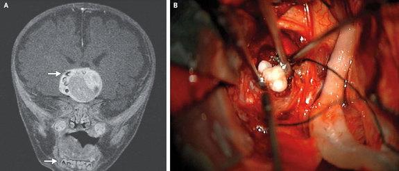 LiveScience's tweet photo. A four-month old infant in Maryland may be the first person to have teeth form in his brain. http://t.co/BEYk0dBgjl http://t.co/QLxKIky98E