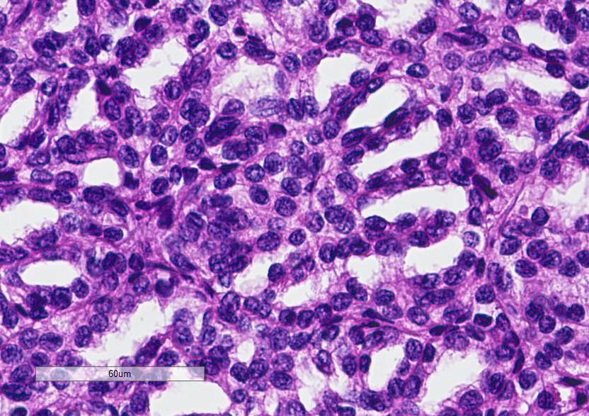 PP_WPA's tweet photo. 70+ y.o. with 4 cm renal tumor. ihc to follow. @Gleason4plus5 @Williamson_SR @RederredeR @MJMagersMD @PathDocBoston http://t.co/w3qOgkqGPN