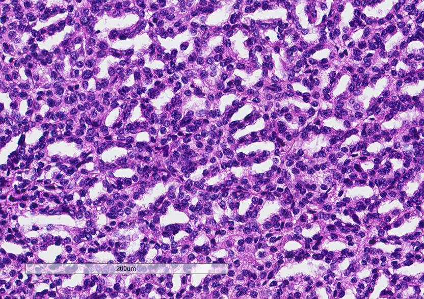 PP_WPA's tweet photo. 70+ y.o. with 4 cm renal tumor. ihc to follow. @Gleason4plus5 @Williamson_SR @RederredeR @MJMagersMD @PathDocBoston http://t.co/w3qOgkqGPN