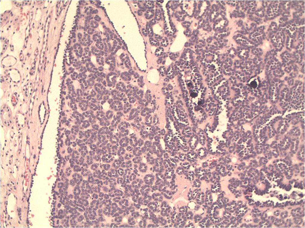 Gleason4plus5's tweet photo. @MJMagersMD @PP_WPA @Williamson_SR This is my metanephric adenoma- typically tubules more obvious, +/- calcs #gupath http://t.co/5fFou4aGYQ