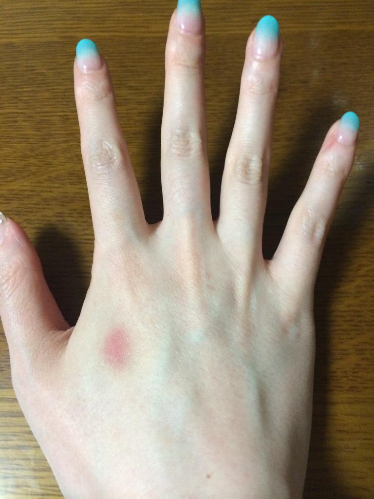 あめ 汚い手 で申し訳ないんですが 今日朝起きたらここに痣が出来てて こんなところにピンポイント 何で って思ってたんだけど クリエ終わって気がついたら私星ペンラを横に持ってシクセンで 手叩いてたからそれで出来た痣でした Http T Co