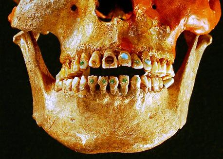 ToothJewels's tweet image. Tooth bling is nothing new! This image depicts an ancient Native American, wearing 'grills' which are 2500 years old!