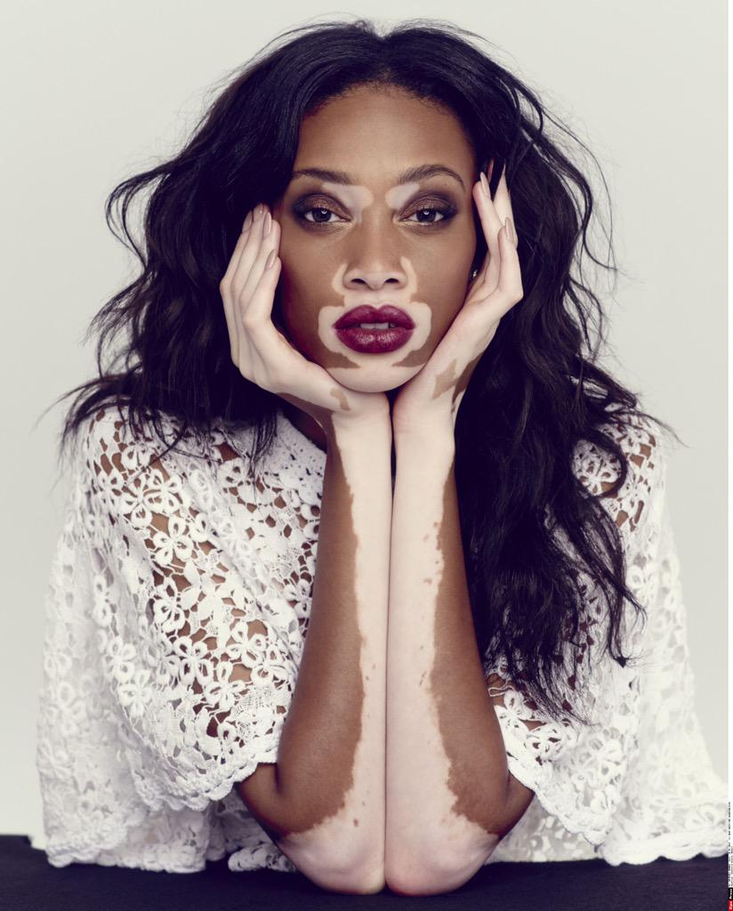 Bonsoir ! on X: "Qui est la mannequin @winnieharlow atteinte de vitiligo ?  #LeTube l'a rencontrée > http://t.co/2ceds6HCar http://t.co/5jvWYqFnZY" / X