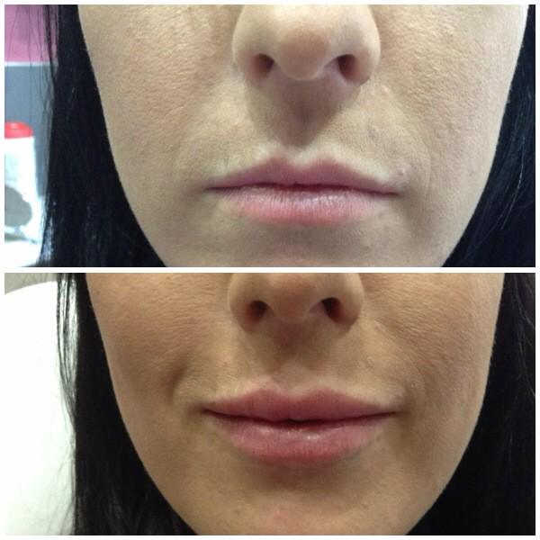 Precise_PMA's tweet image. With my dental 'fairy fingers' I perform facial aesthetics in a safe, clinical environment @spabannockburn MediSpa