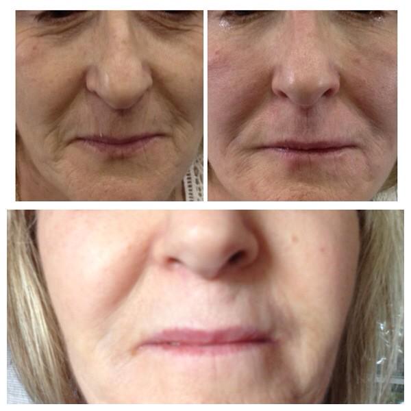 Precise_PMA's tweet image. Dermal Fillers can take years off your eyes and mouth area. No more dark circles!This lady is delighted! 01786 812852