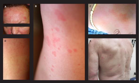 Latest insights into the newly recognized condition NOD2-associated autoinflammatory disease cle.clinic/1Gh9iPh