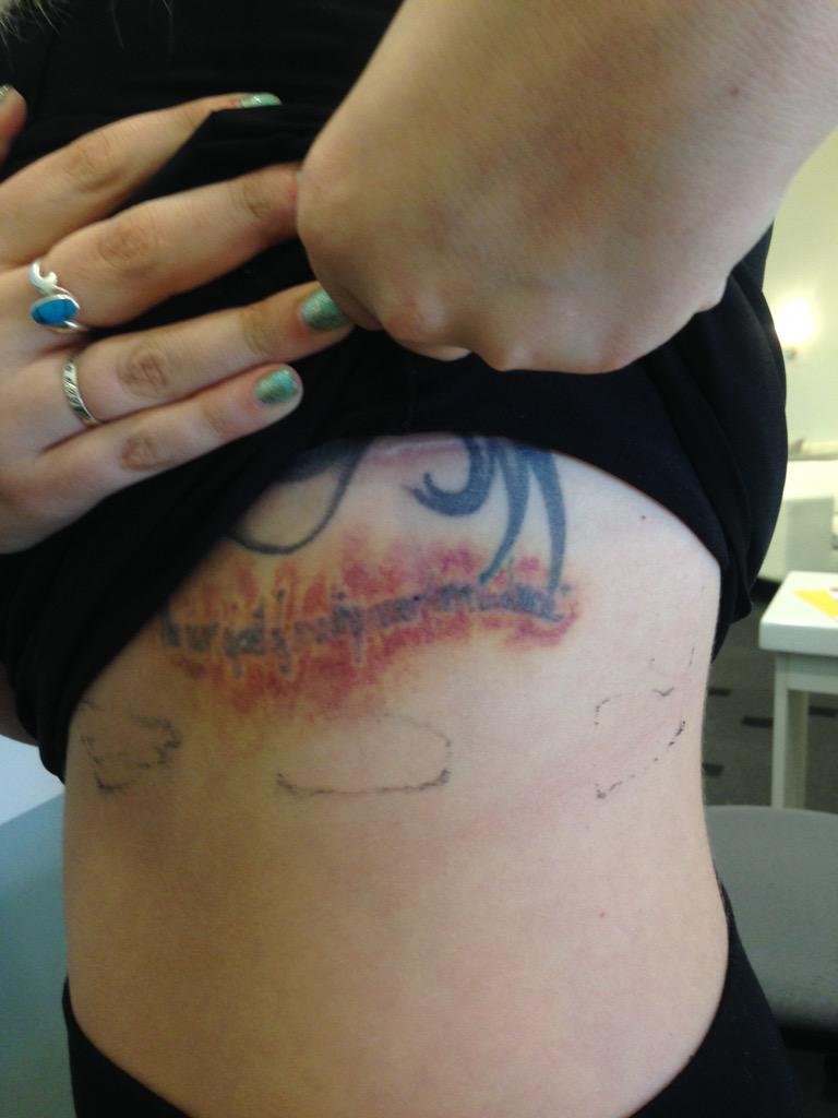 Hartford Laser Tattoo Removal | South Windsor Removery