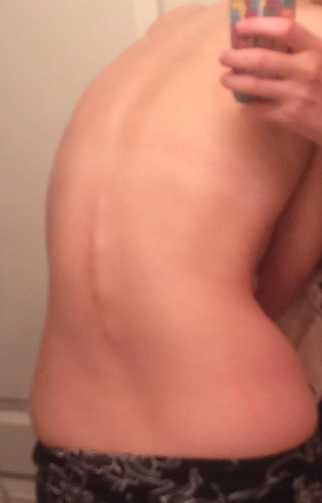 IsaJennie's tweet photo. Why my doctors nicknamed me stegosaurus #WhatIsEDS #EDS6 http://t.co/4wn2Aapv95