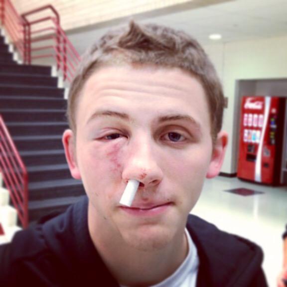 simply_brendan's tweet photo. I know your pain Mike... #BrokenFaceBros #LeftyBros #Number11Bros http://t.co/1hwOYmwXGy