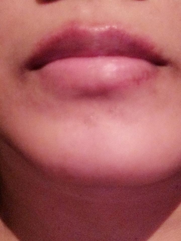 theemoqueeen's tweet image. This chapped lip is getting worse. #dryness #cold #worldproblem