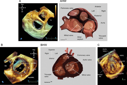 EchoResPract's tweet photo. A review outlining #3Decho of the left #atrioventricular valve as opposed to #2Dimaging
 http://t.co/S93y0rYWUq http://t.co/FDmEaCjwAC