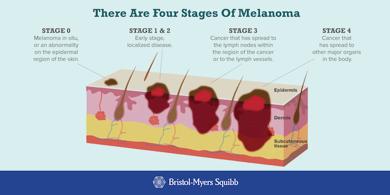 Биопсия при меланоме. Типичная локализация меланомы.
