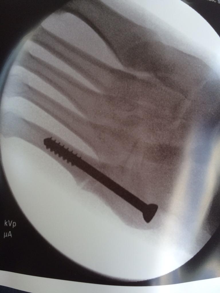 PelkaDots's tweet photo. Go go gadget screw driver #BionicFoot http://t.co/0NQHPv1TxB