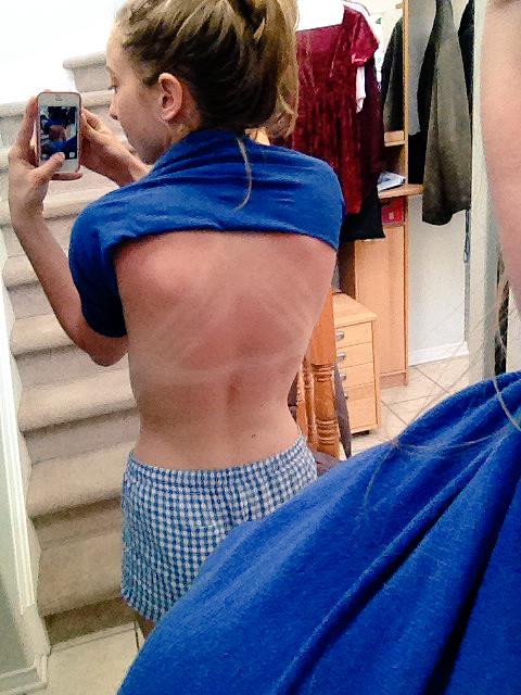 LauraEmilieM's tweet photo. Aftermath of #phyoga : burnt and sore. #worth #willgoagain http://t.co/D1T7YZi8IA