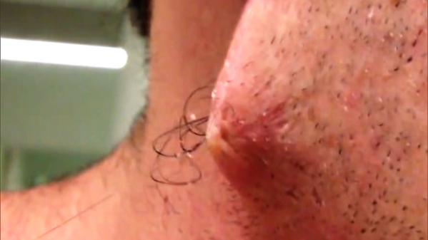 The Doctors On Twitter Bedtime Story The Longest Ingrown Hair