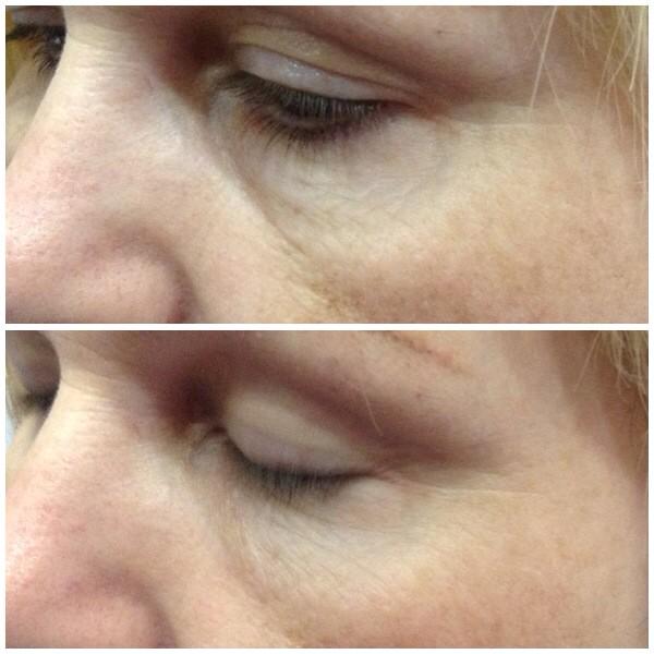 Precise_PMA's tweet image. Dark circles can age your face. I treated this lady with Juvederm Volbella to rejuvenate her eyes. 01786 812852