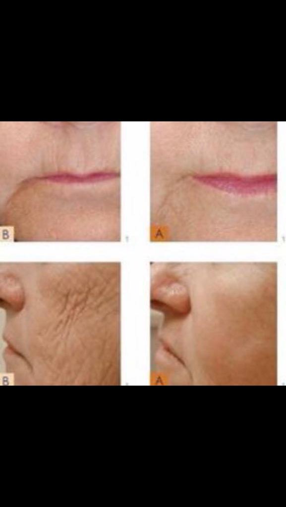 SharonChaz's tweet photo. 🌟Want to be instantly ageless without Botox! Now you can 😁🌟 #instantlyageless #beauty #love #amazingresults http://t.co/7rSYTY0DeD